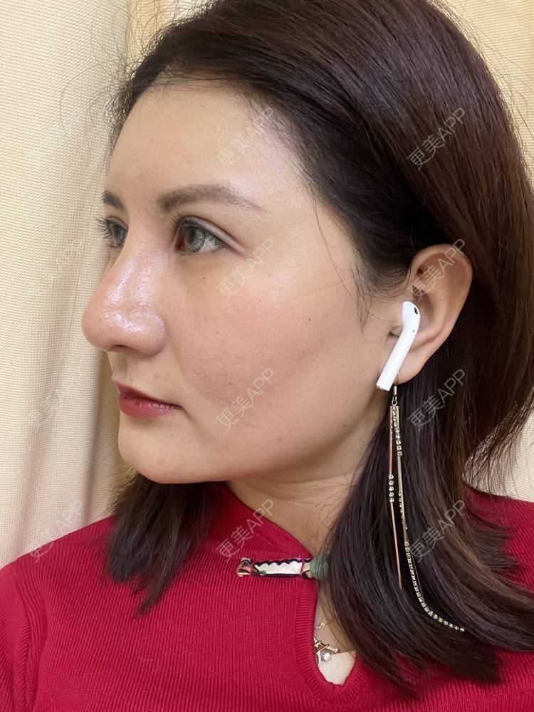 更美 - 冰妖娆的除皱瘦脸经验 | 除皱瘦脸 | 上海