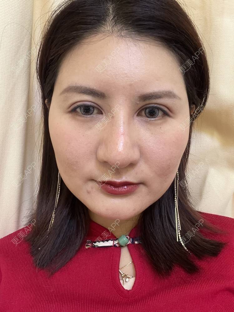 更美 - 冰妖娆的除皱瘦脸经验 | 除皱瘦脸 | 上海