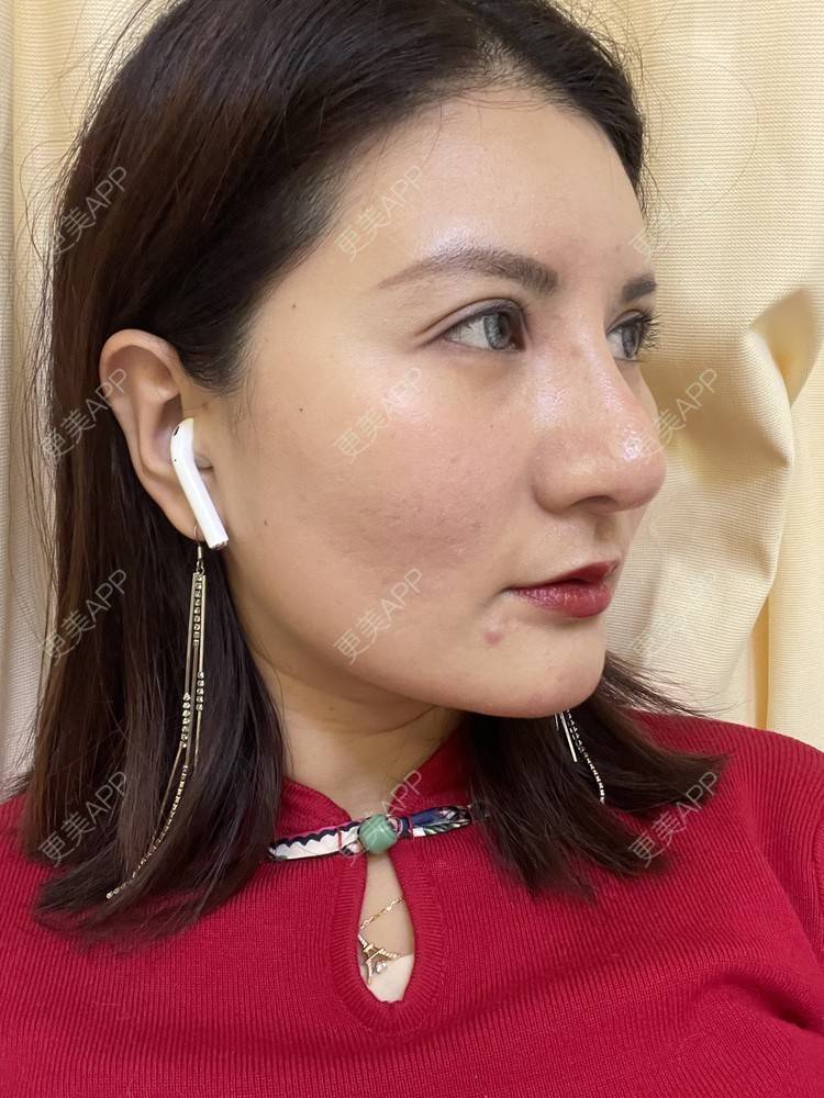 更美 - 冰妖娆的除皱瘦脸经验 | 除皱瘦脸 | 上海