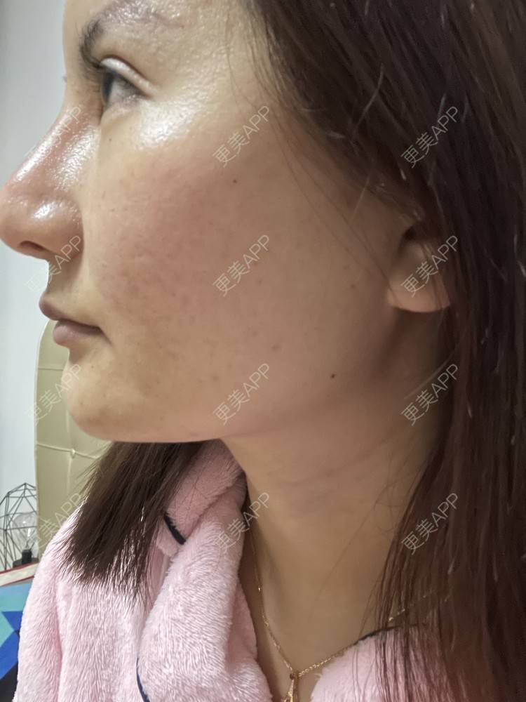 更美 - 冰妖娆的除皱瘦脸经验 | 除皱瘦脸 | 上海