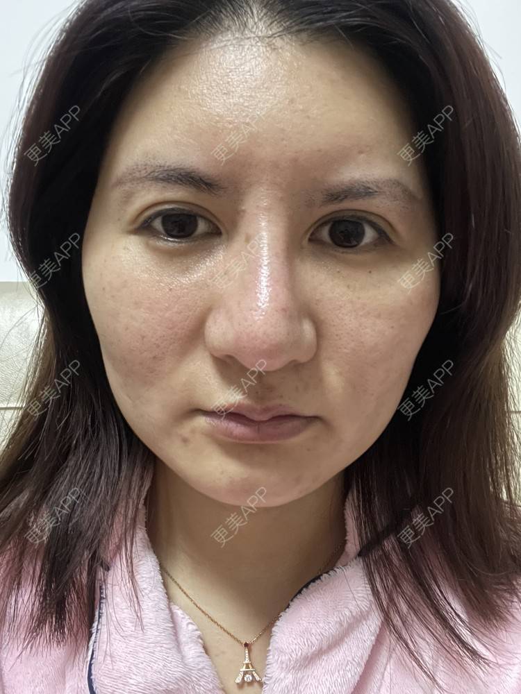 更美 - 冰妖娆的除皱瘦脸经验 | 除皱瘦脸 | 上海