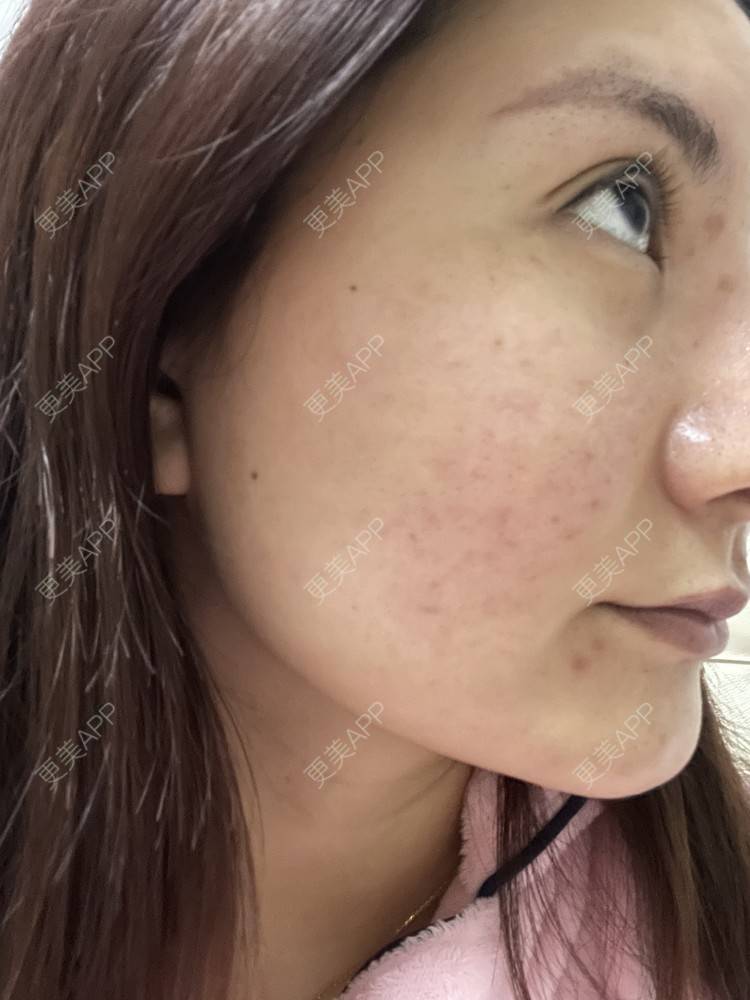 更美 - 冰妖娆的除皱瘦脸经验 | 除皱瘦脸 | 上海