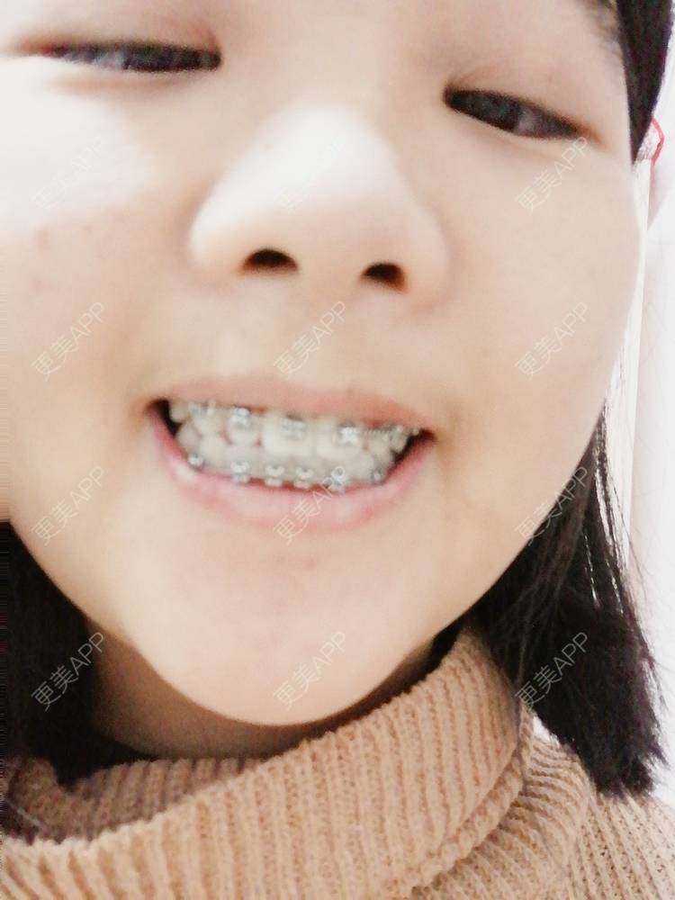 更美 - 鱼不咸咸的金属托槽矫正经验 | 金属托槽矫正 | 成都