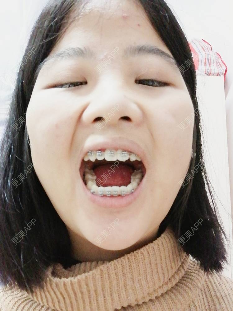 更美 - 鱼不咸咸的金属托槽矫正经验 | 金属托槽矫正 | 成都