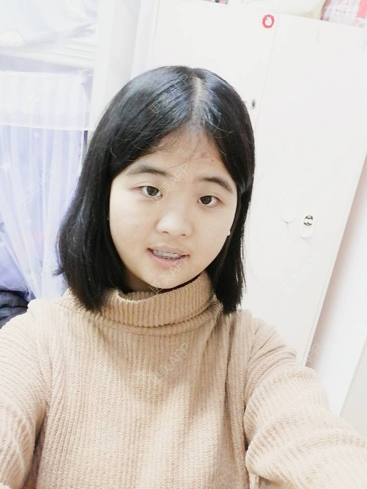 更美 - 鱼不咸咸的金属托槽矫正经验 | 金属托槽矫正 | 成都