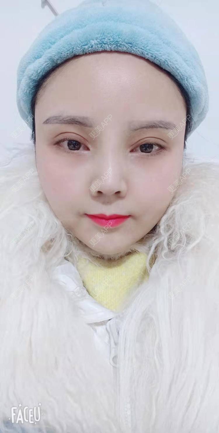 更美 - 更美用户PVvylmTjJA的自体脂肪全面部填充经验 | 长沙 | 自体脂肪全面部填充