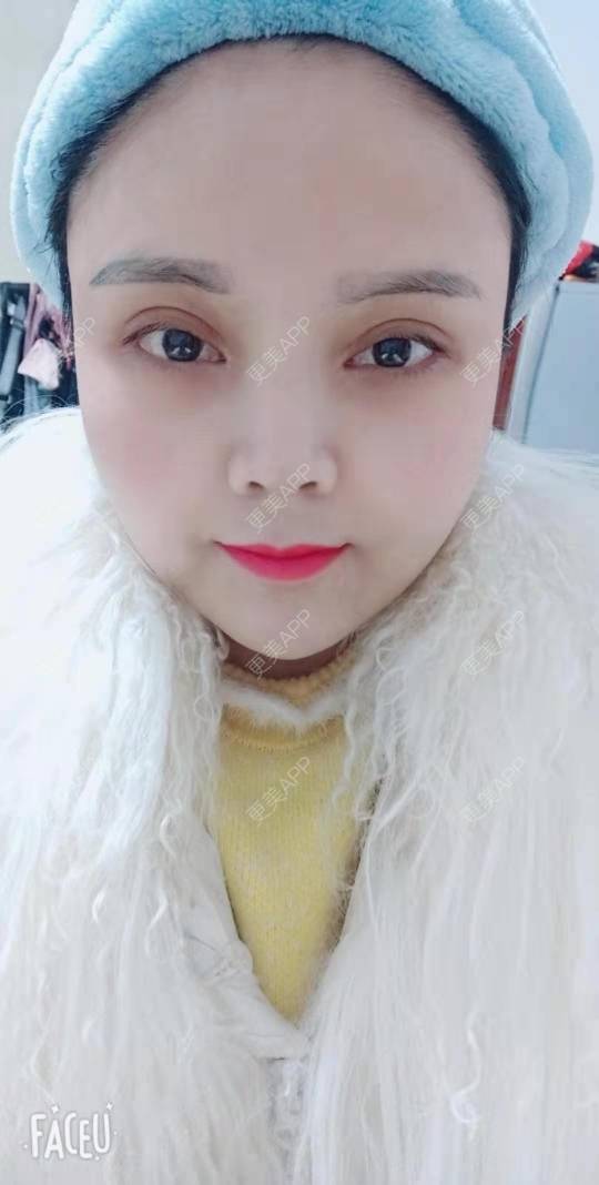 更美 - 更美用户PVvylmTjJA的自体脂肪全面部填充经验 | 长沙 | 自体脂肪全面部填充