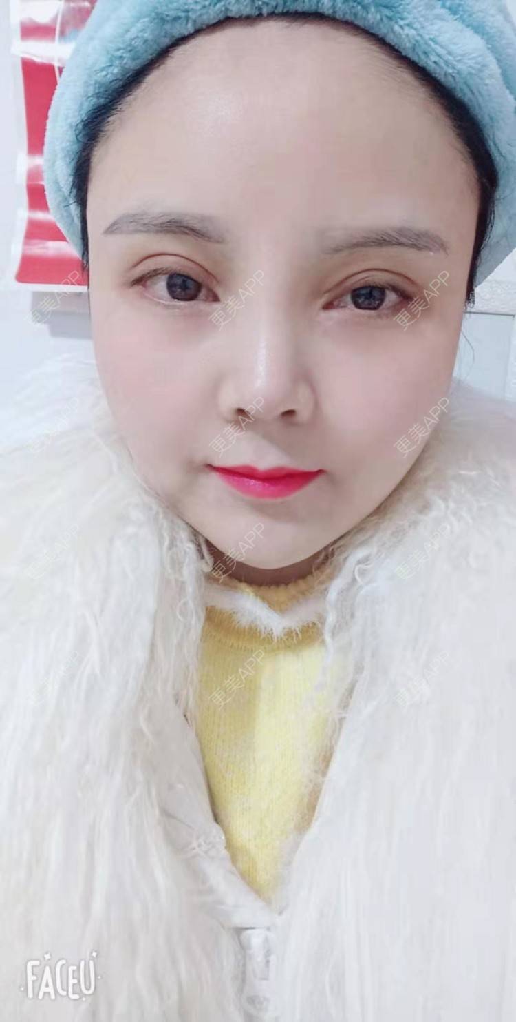 更美 - 更美用户PVvylmTjJA的自体脂肪全面部填充经验 | 长沙 | 自体脂肪全面部填充