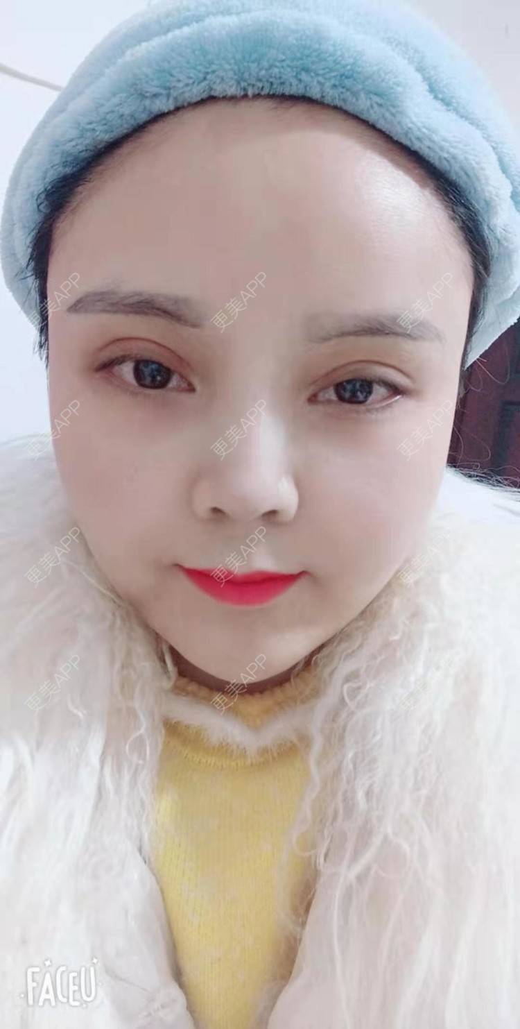 更美 - 更美用户PVvylmTjJA的自体脂肪全面部填充经验 | 长沙 | 自体脂肪全面部填充