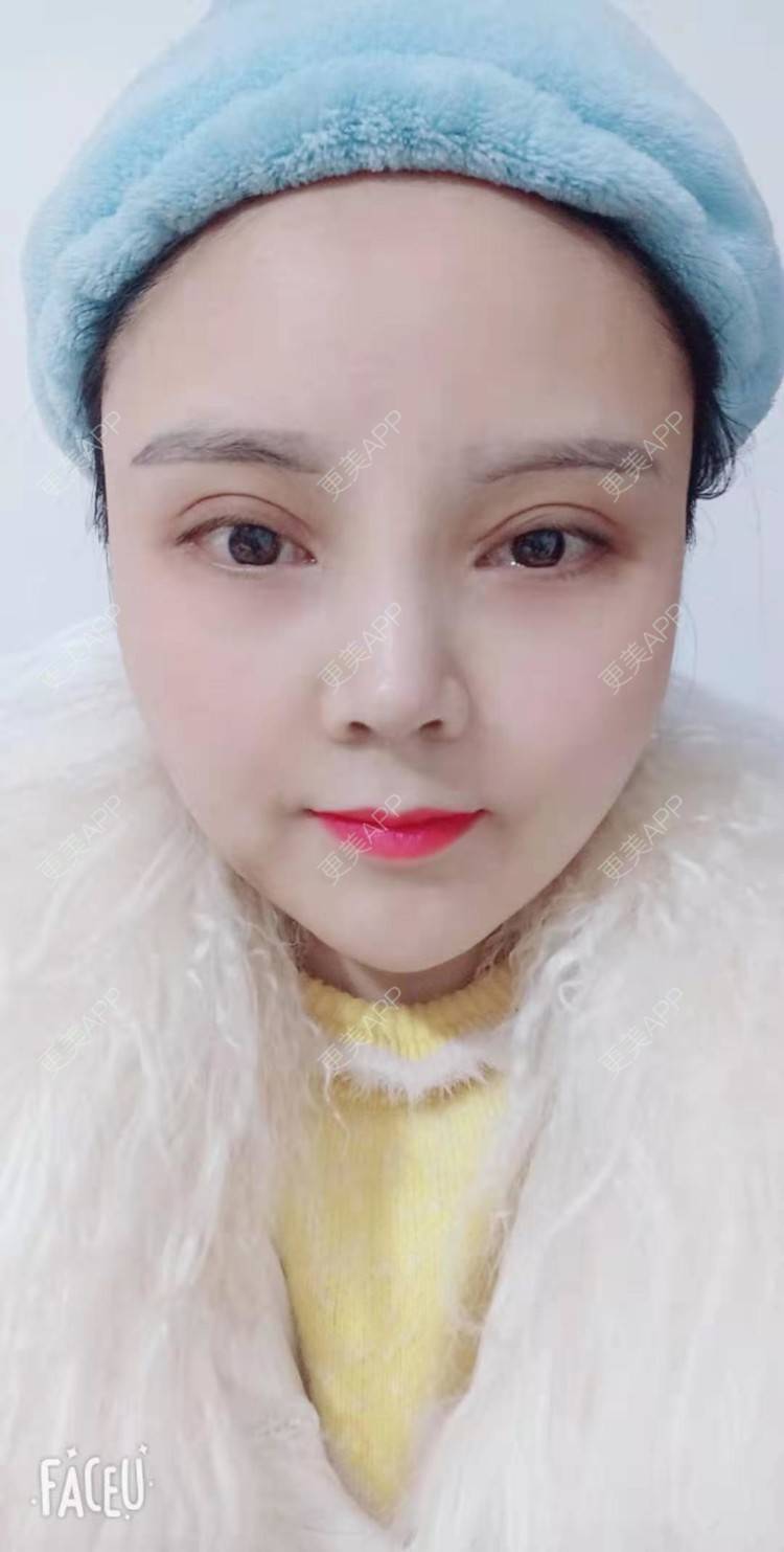 更美 - 更美用户PVvylmTjJA的自体脂肪全面部填充经验 | 长沙 | 自体脂肪全面部填充