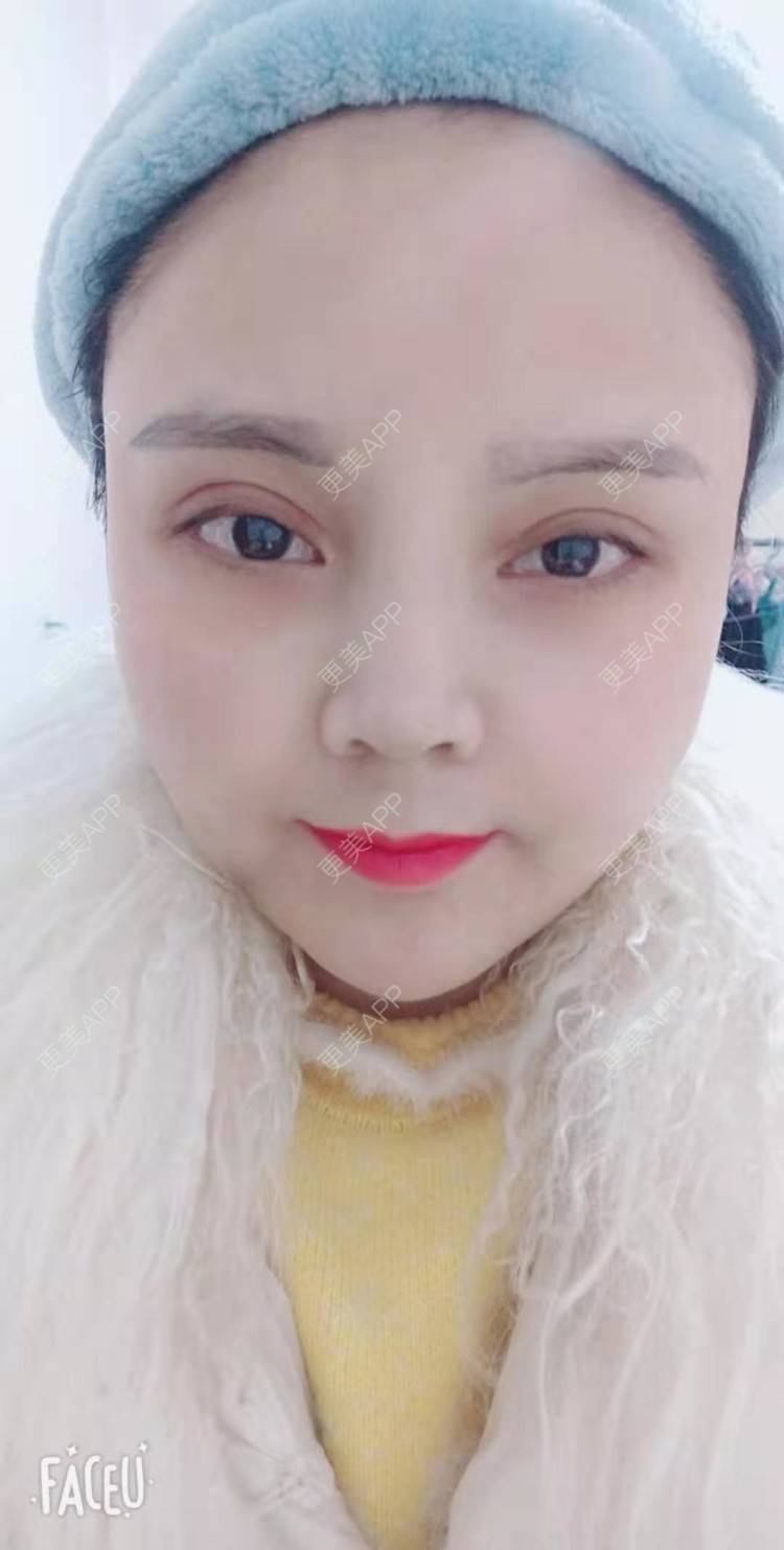 更美 - 更美用户PVvylmTjJA的自体脂肪全面部填充经验 | 长沙 | 自体脂肪全面部填充