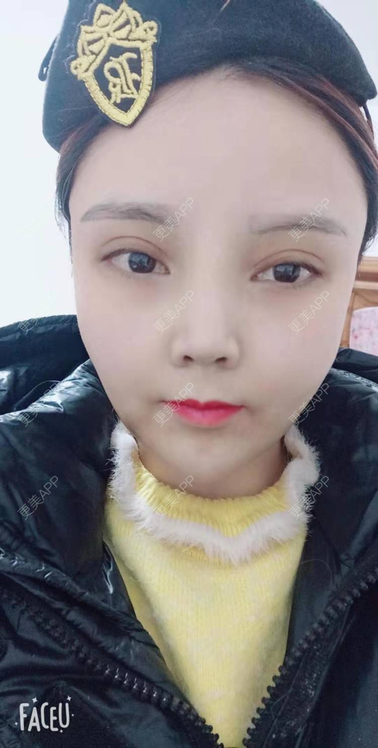 更美 - 更美用户PVvylmTjJA的手臂吸脂经验 | 手臂吸脂 | 长沙