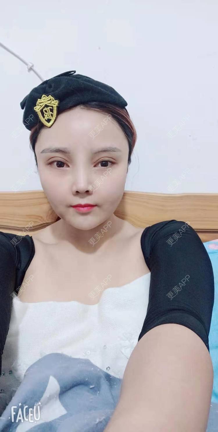 更美 - 更美用户PVvylmTjJA的手臂吸脂经验 | 手臂吸脂 | 长沙
