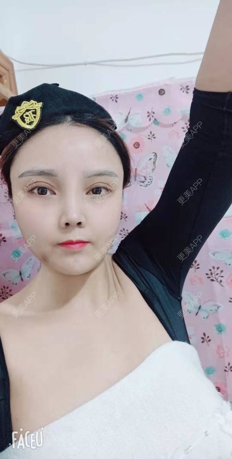 更美 - 更美用户PVvylmTjJA的手臂吸脂经验 | 手臂吸脂 | 长沙