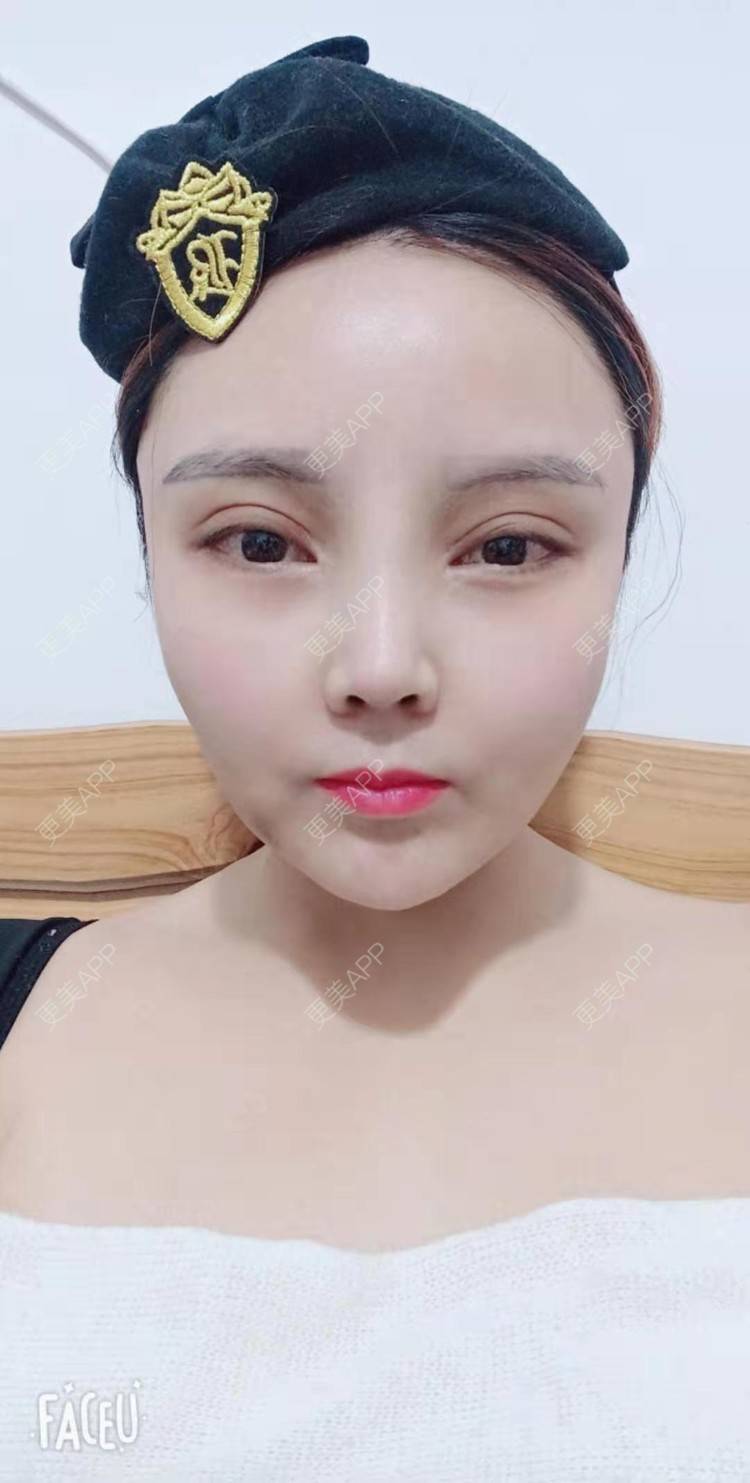 更美 - 更美用户PVvylmTjJA的手臂吸脂经验 | 手臂吸脂 | 长沙