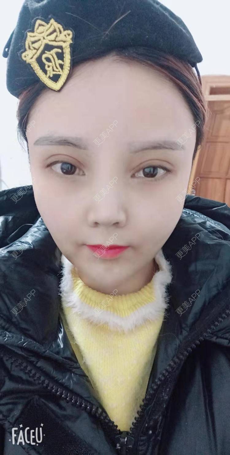 更美 - 更美用户PVvylmTjJA的手臂吸脂经验 | 手臂吸脂 | 长沙