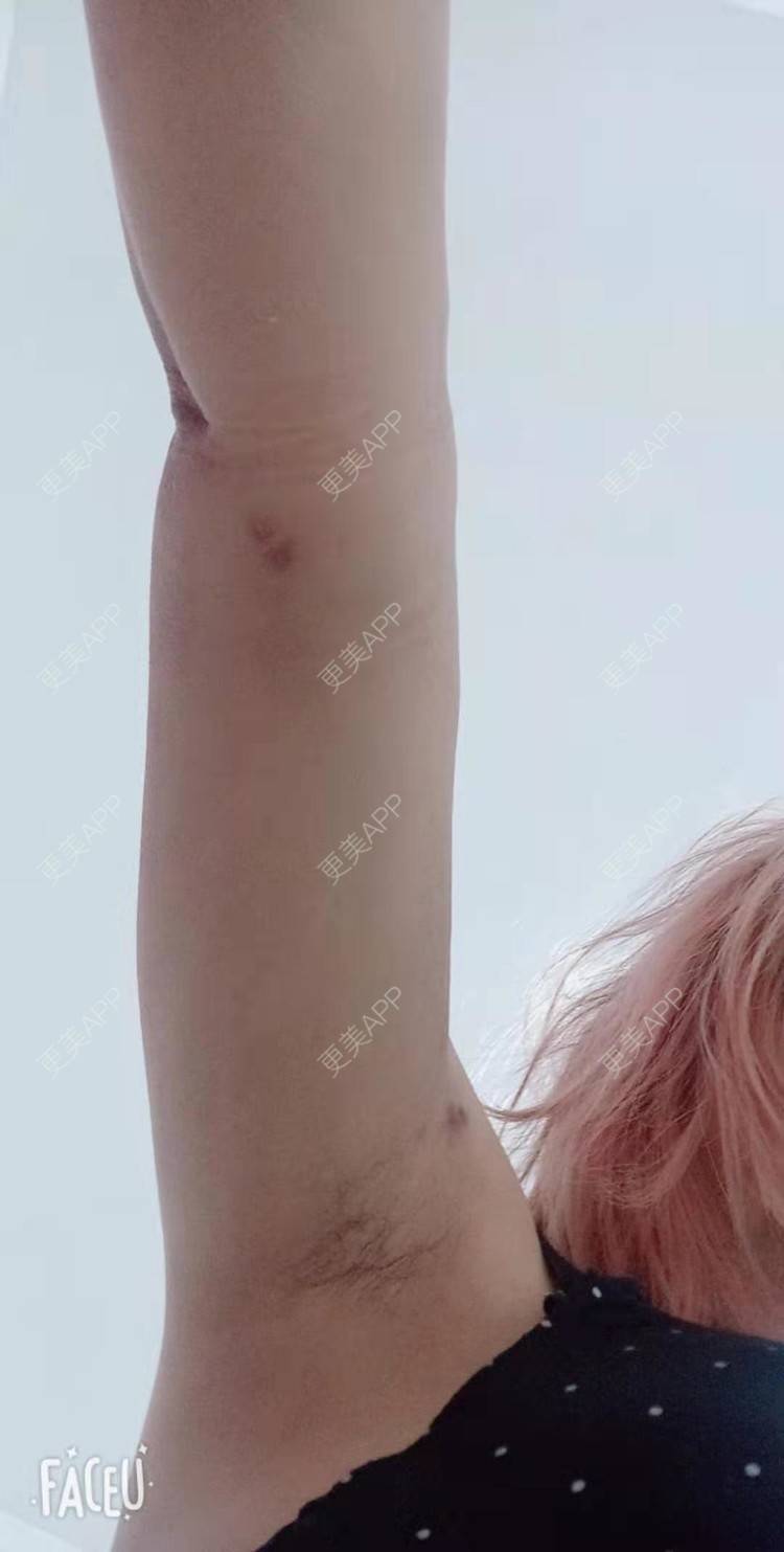更美 - 更美用户PVvylmTjJA的手臂吸脂经验 | 手臂吸脂 | 长沙