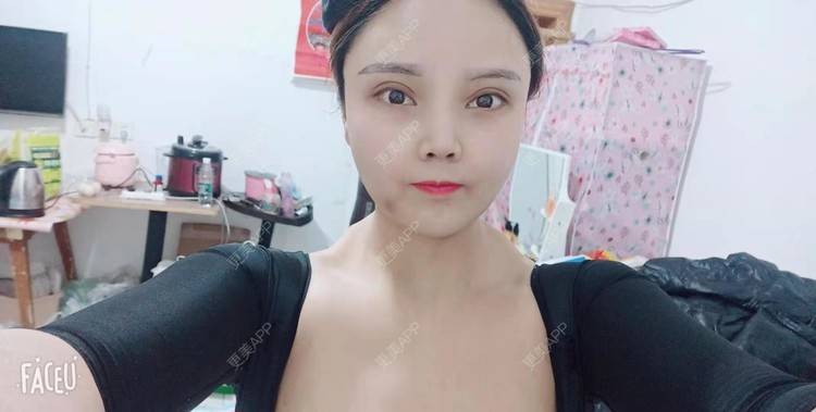 更美 - 更美用户PVvylmTjJA的手臂吸脂经验 | 手臂吸脂 | 长沙