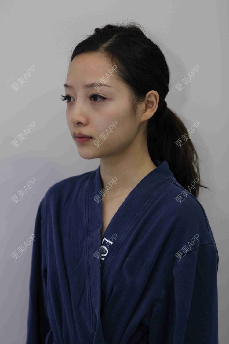 更美 - 佳人人家的鼻部多项经验 | 视频日记 | 鼻部多项 | 重庆