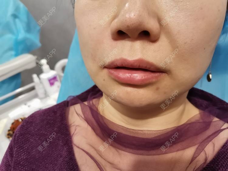 更美 - 苗苗美女的玻尿酸鼻基底经验 | 玻尿酸鼻基底 | 上海
