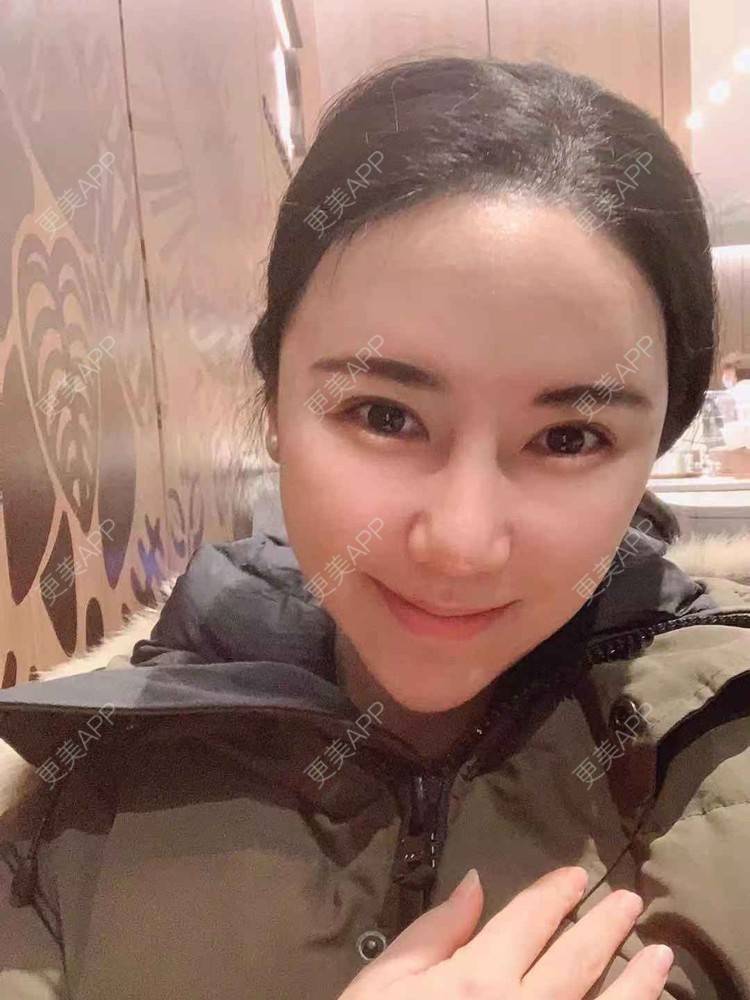 更美 - 细雨微风心微凉的酒窝成形经验 | M唇成形 | 微笑唇手术 | 唇综合 | 厚唇改薄 | 唇腭裂修复 | 酒窝成形 | 唇形