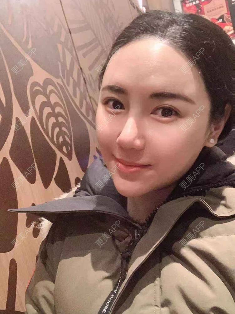 更美 - 细雨微风心微凉的酒窝成形经验 | M唇成形 | 微笑唇手术 | 唇综合 | 厚唇改薄 | 唇腭裂修复 | 酒窝成形 | 唇形