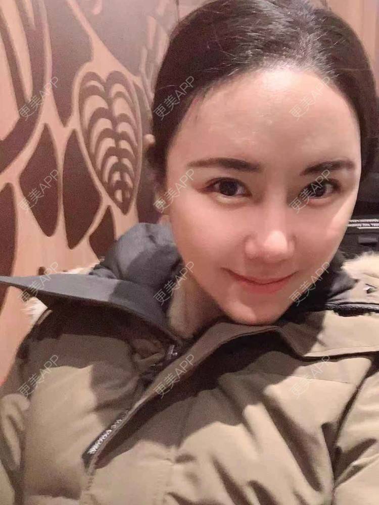 更美 - 细雨微风心微凉的酒窝成形经验 | M唇成形 | 微笑唇手术 | 唇综合 | 厚唇改薄 | 唇腭裂修复 | 酒窝成形 | 唇形