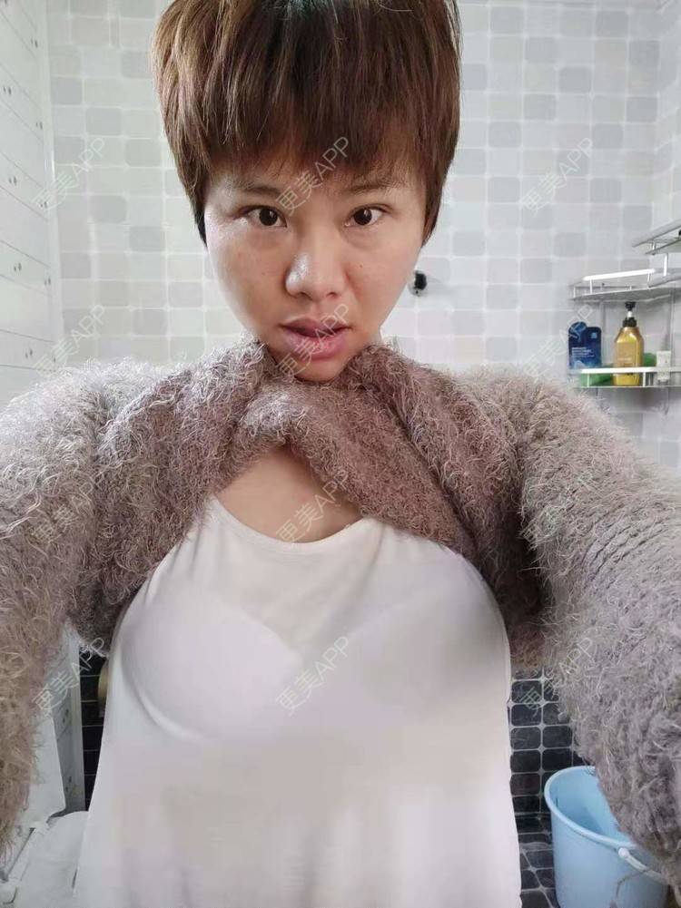 更美 - 更美用户gZFN64zuwo的丰胸（隆胸）经验 | 自体脂肪隆胸 | 手术去副乳 | 乳房再造 | 美胸套餐 | 乳头内陷矫正 | 丰胸（隆胸） | 假体隆胸 | 胸部下垂矫正 | 重庆 | 胶原蛋白丰胸 | 复合隆胸