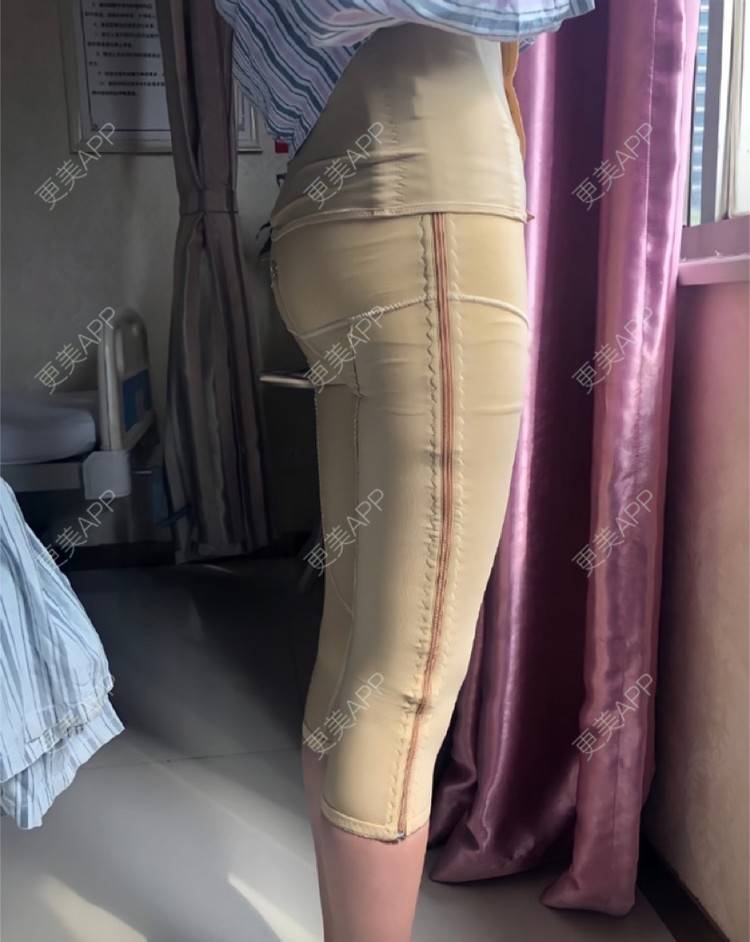 更美 - 更美用户czf9bjXMQu的吸脂经验 | 长沙 | 吸脂