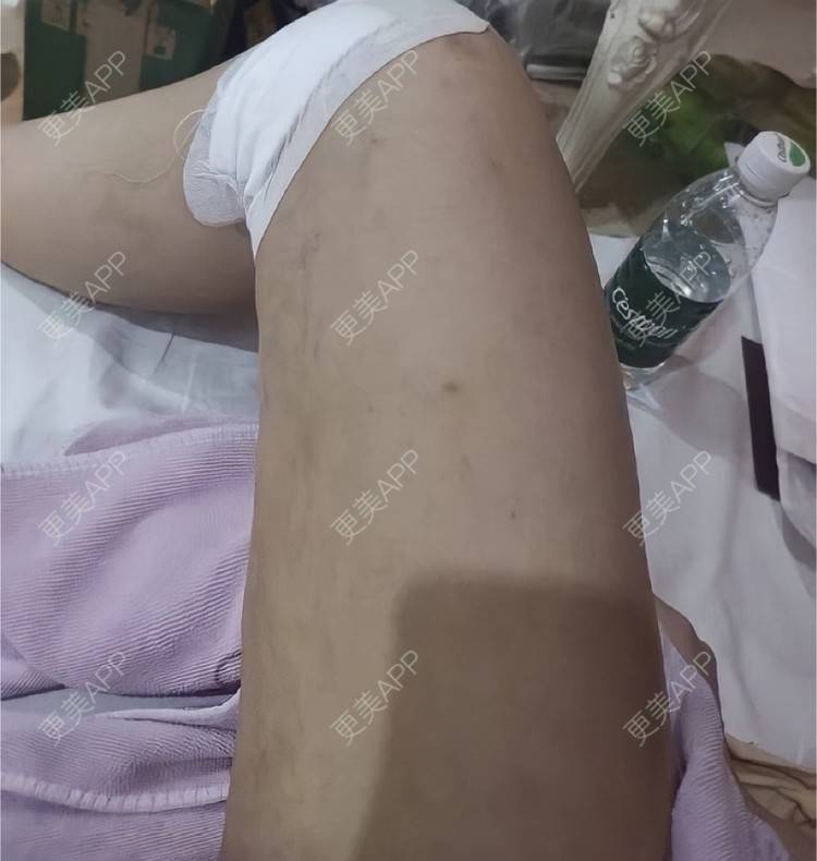 更美 - Ttuxrux的吸脂经验 | 长沙 | 吸脂