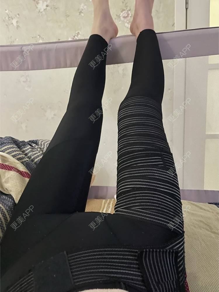 更美 - ▓我穿内裤我自信豪的吸脂经验 | 长沙 | 吸脂