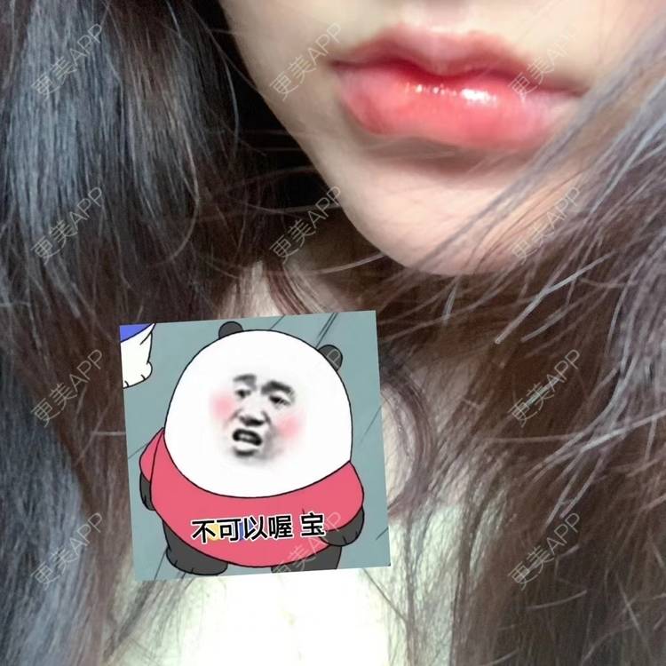 更美 - 鴘鴿的厚唇改薄经验 | 视频日记 | 厚唇改薄 | M唇成形 | 唇综合 | 汕尾