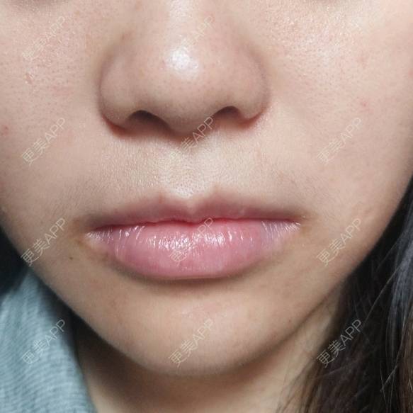 更美 - 鴘鴿的厚唇改薄经验 | 视频日记 | 厚唇改薄 | M唇成形 | 唇综合 | 汕尾