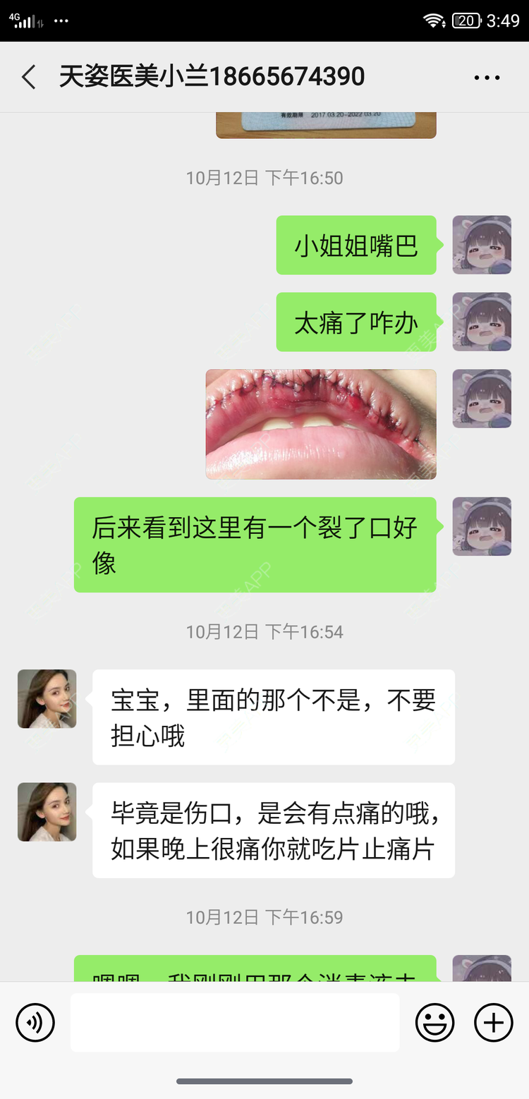 更美 - 鴘鴿的厚唇改薄经验 | 视频日记 | 厚唇改薄 | M唇成形 | 唇综合 | 汕尾