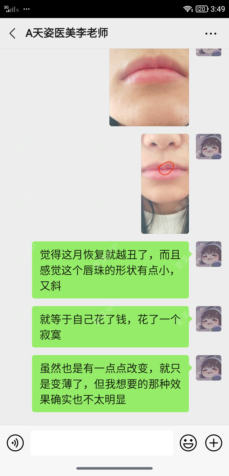 更美 - 鴘鴿的厚唇改薄经验 | 视频日记 | 厚唇改薄 | M唇成形 | 唇综合 | 汕尾