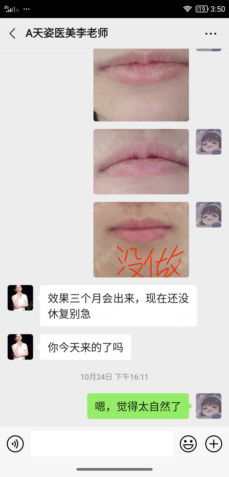 更美 - 鴘鴿的厚唇改薄经验 | 视频日记 | 厚唇改薄 | M唇成形 | 唇综合 | 汕尾