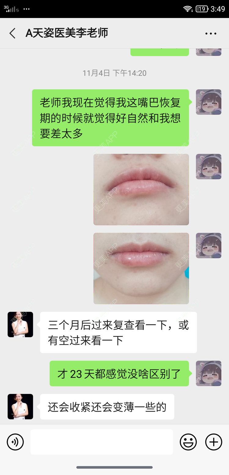 更美 - 鴘鴿的厚唇改薄经验 | 视频日记 | 厚唇改薄 | M唇成形 | 唇综合 | 汕尾