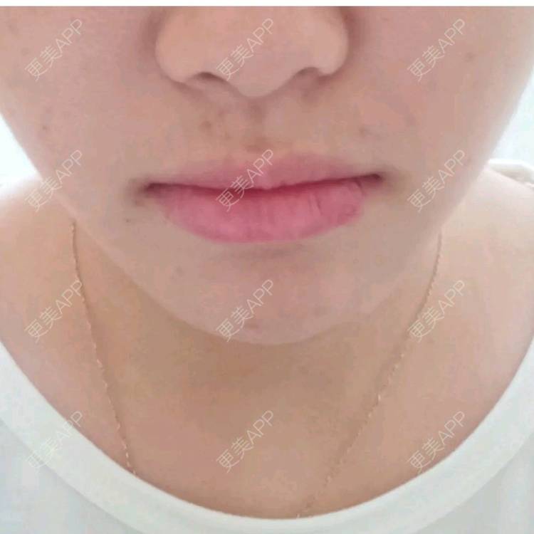 更美 - 鴘鴿的厚唇改薄经验 | 厚唇改薄 | 汕尾 | M唇成形 | 唇综合 | 视频日记