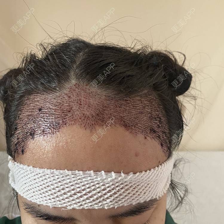 更美 - 更美用户G57MbOXLSZ的植发际线经验 | 植发际线 | 广州