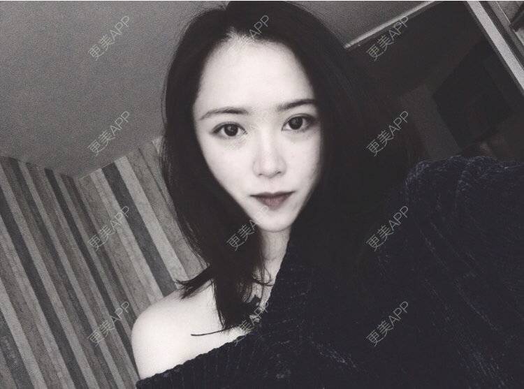 更美 - 暴力养猪妹到的颧骨颧弓经验 | 郴州 | 颧骨颧弓