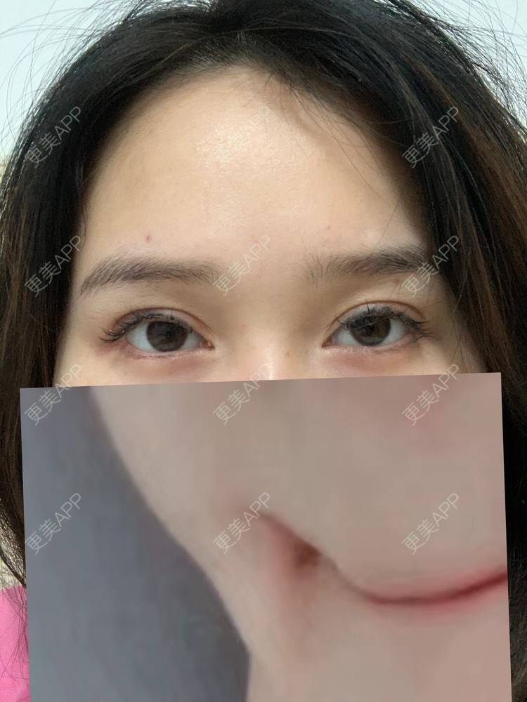 更美 - 土豆丝炒蛋的双眼皮经验 | 双眼皮 | 重庆