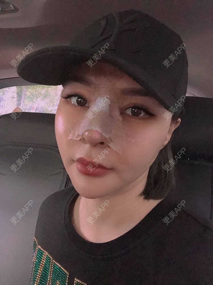 更美 - 更美用户w7xzDQyhGZ的鼻部多项经验 | 肋软骨隆鼻 | 鼻部硅胶假体取出 | 鼻部多项 | 鼻形态修复