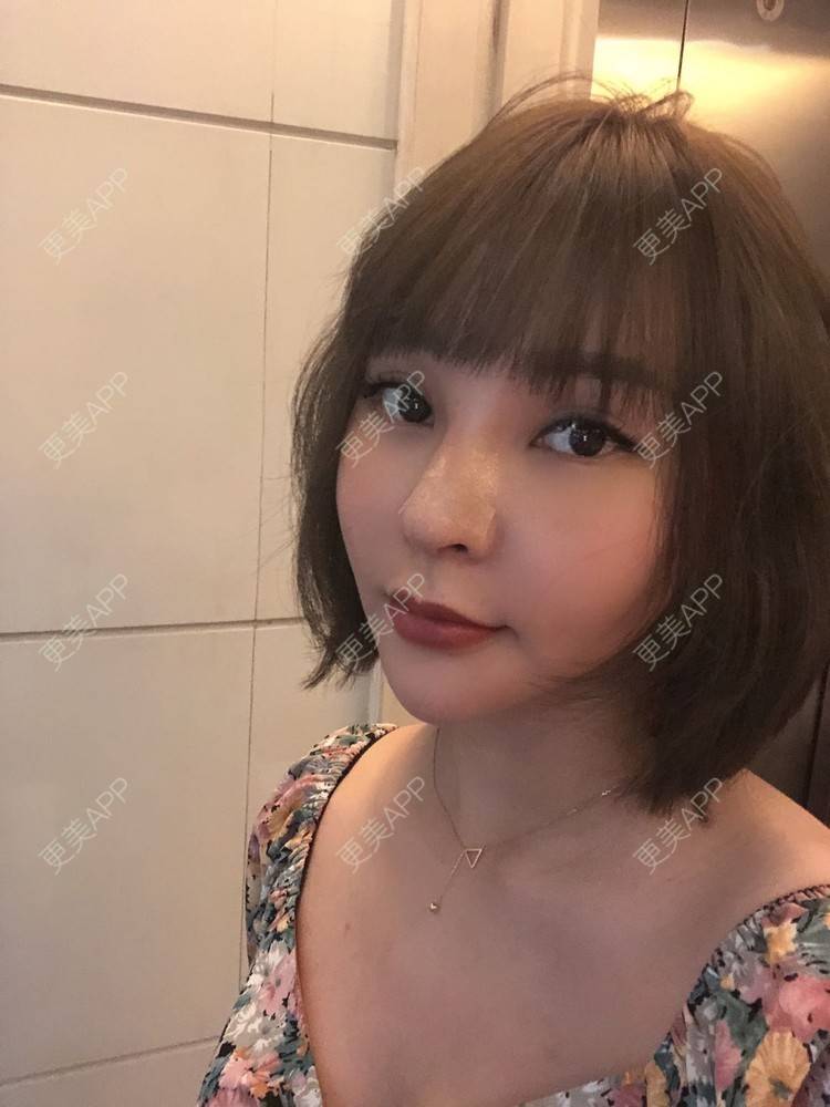更美 - 更美用户w7xzDQyhGZ的鼻部多项经验 | 肋软骨隆鼻 | 鼻部硅胶假体取出 | 鼻部多项 | 鼻形态修复