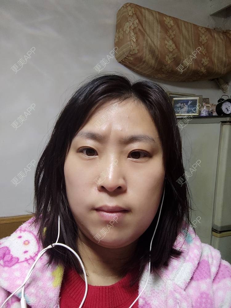 更美 - 写在歌里的玻尿酸鼻部经验 | 除皱瘦脸 | 上海