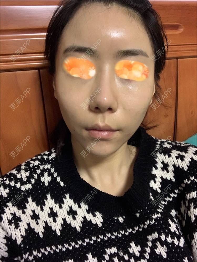 更美 - 👠蜡笔小新灬的自体脂肪全面部填充经验 | 上海 | 自体脂肪全面部填充