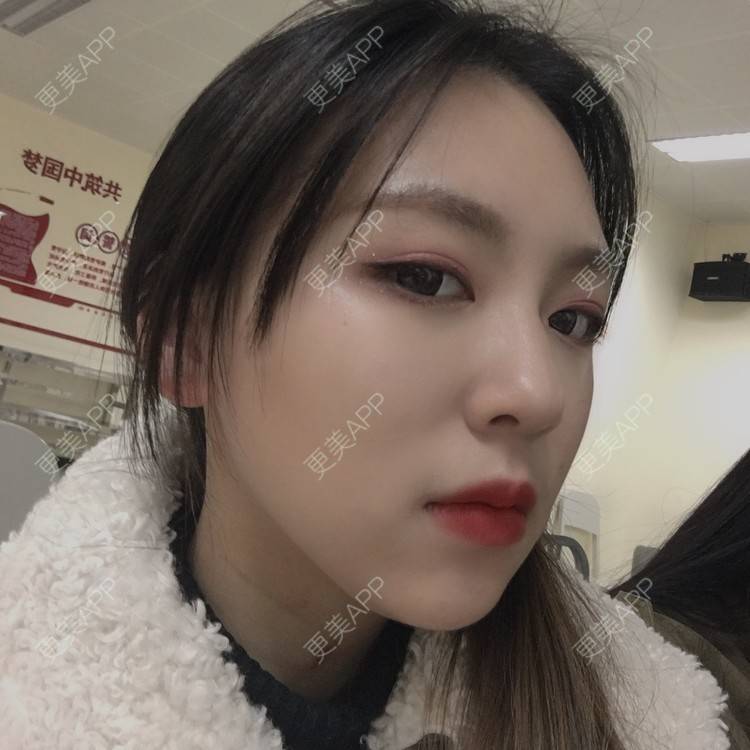 更美 - 吃飯從來用湯勺√的自体脂肪隆鼻经验 | 成都 | 自体脂肪隆鼻 | 视频日记