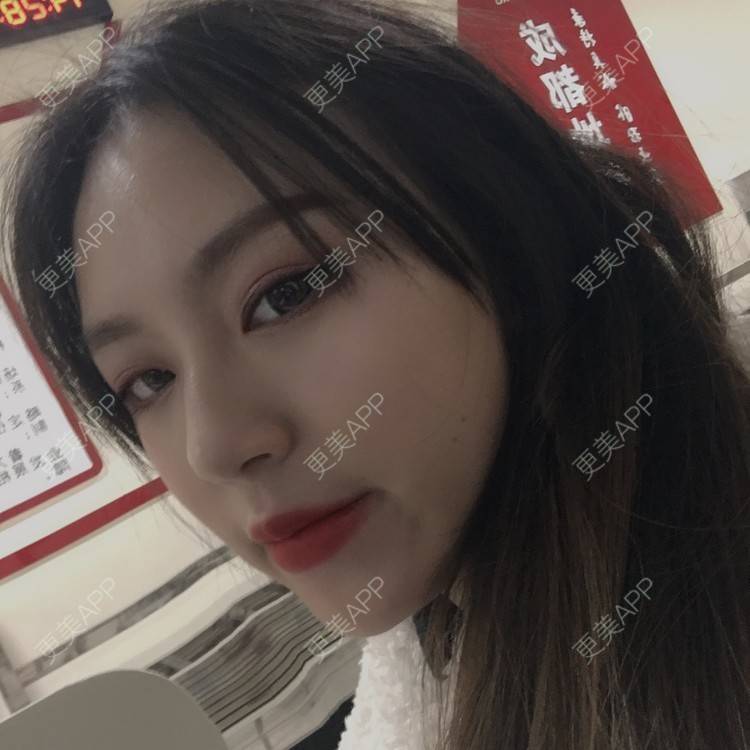 更美 - 吃飯從來用湯勺√的自体脂肪隆鼻经验 | 成都 | 自体脂肪隆鼻 | 视频日记
