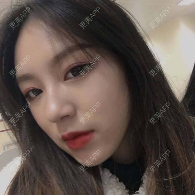 更美 - 吃飯從來用湯勺√的自体脂肪隆鼻经验 | 成都 | 自体脂肪隆鼻 | 视频日记