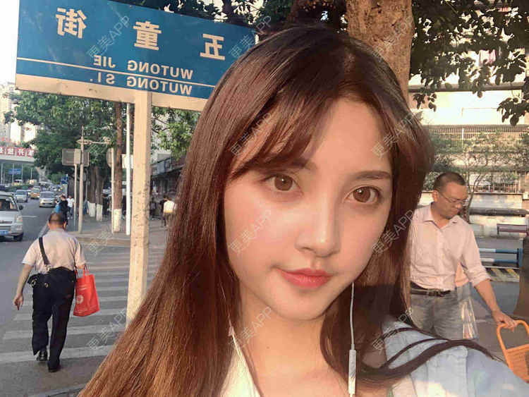 更美 - 安静的粥的自体脂肪全面部填充经验 | 自体脂肪全面部填充 | 视频日记 | 重庆