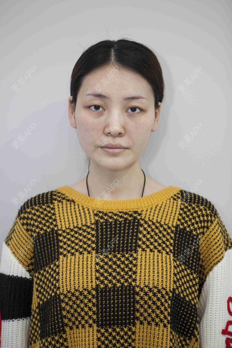 更美 - 芝麻芝麻开开门的自体脂肪全面部填充经验 | 自体脂肪全面部填充 | 视频日记 | 重庆